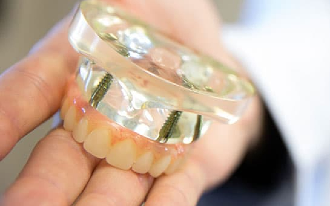 full mouth implant model