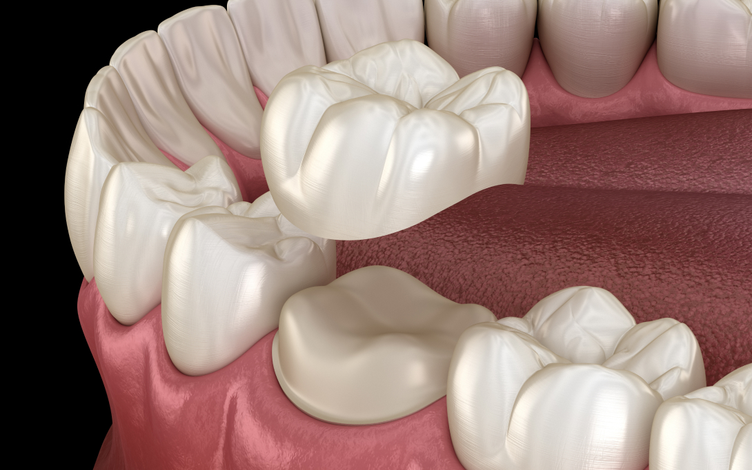 dental crowns