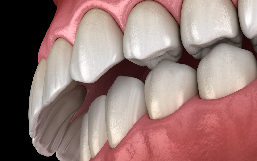 overbite 3d graphic