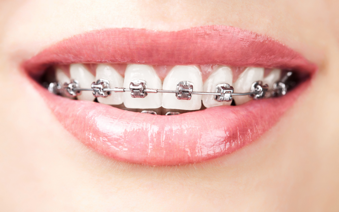 dental patient smiling with braces close up
