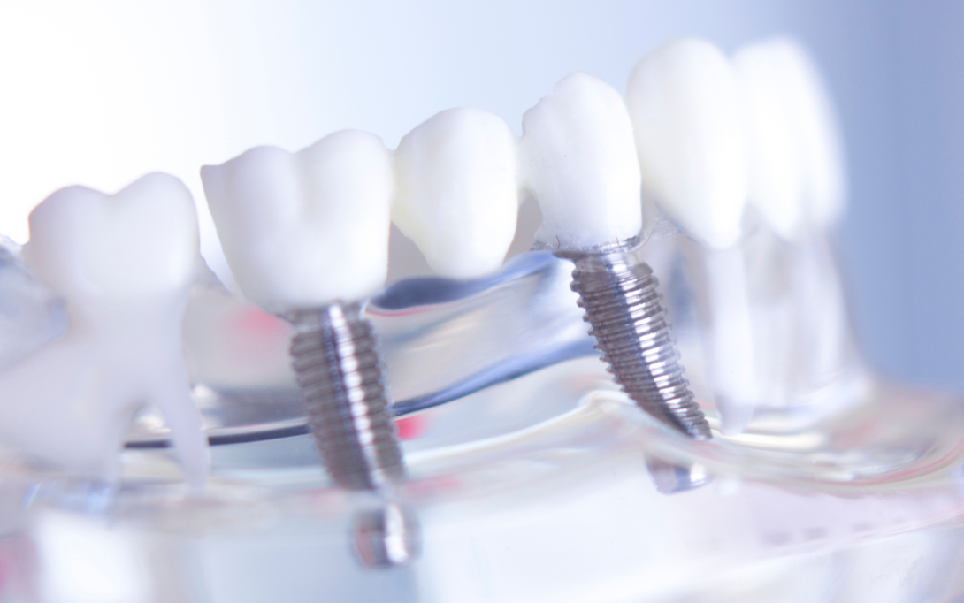 implant bridge