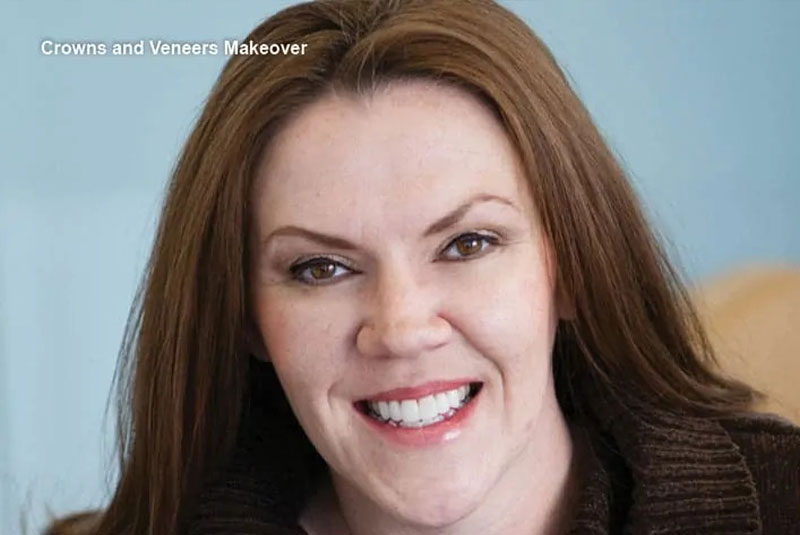 jessica - crowns patient